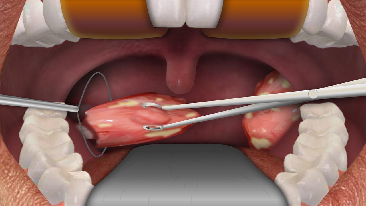 Tonsillectomy In Adults Procedures And Recovery New Health Advisor