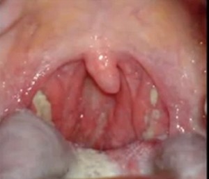 sfære Jordbær brydning 11 Causes of White Spots on the Throat (with Pictures) | New Health Advisor