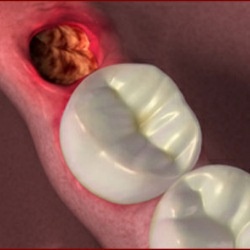 food stuck in holes after wisdom teeth removal