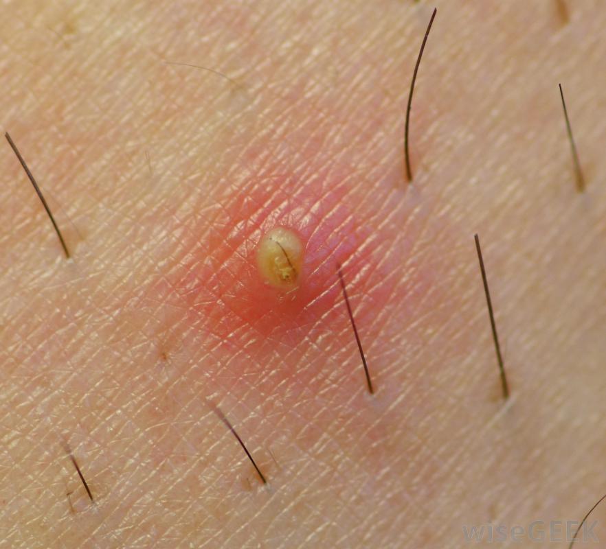 Infected Ingrown Hair Symptoms And Treatments New Health Advisor