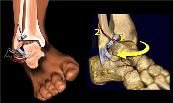 Ankle Avulsion Fracture Treatments And Rehabilitation | New Health Advisor