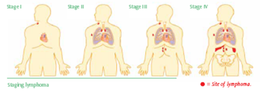 All You Need To Know About Hodgkin S Lymphoma New Health Advisor