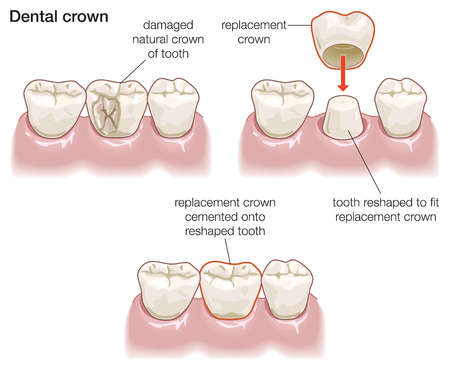 how much should a crown for tooth cost