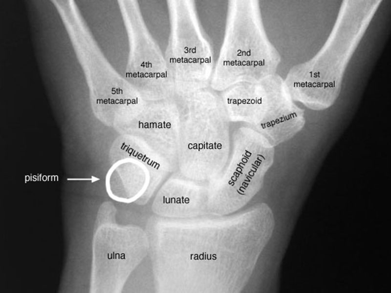 Scapholunate Ligament Tear Treatments | New Health Advisor