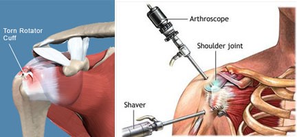 recovery time for rotator cuff repair