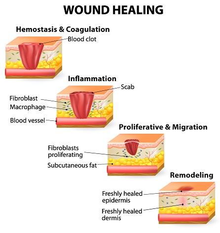 Diagnosis Of A Stages Of Wound Healing