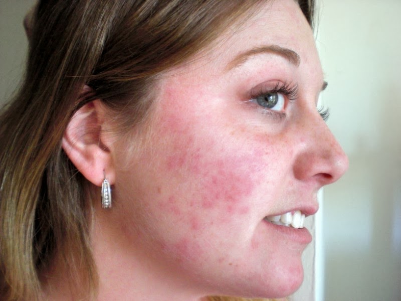Allergic reaction causing swollen face