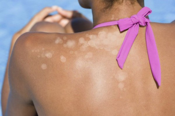 Besiddelse Polar Afsky Why You Get White Spots from Tanning and Ways to Help | New Health Advisor