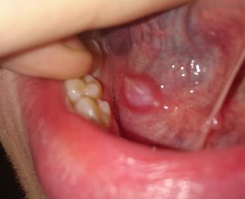 bump under tongue behind teeth