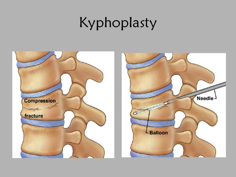 How Long Is The Kyphoplasty Recovery Time New Health Advisor