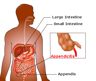 Symptoms of Appendicitis | New Health Advisor