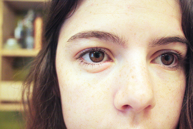 What Causes Bags Under Eyes? New Health Advisor