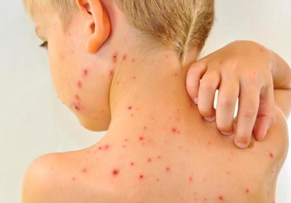 Can You Get Chickenpox Twice New Health Advisor