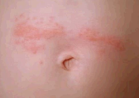 Rash Around Belly Button: Causes and Treatments