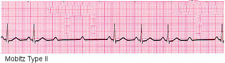 What Is 2nd Degree Heart Block? | New Health Advisor
