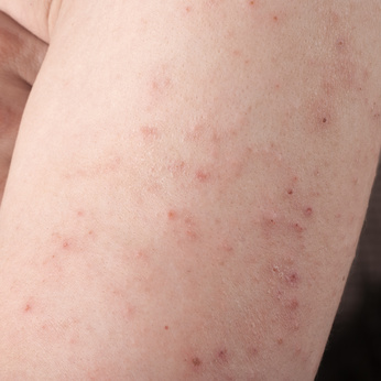 Rashes That Come and Go: 5 Possible Causes and Corresponding Treatments