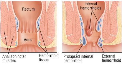 Do Hemorrhoids Go Away
