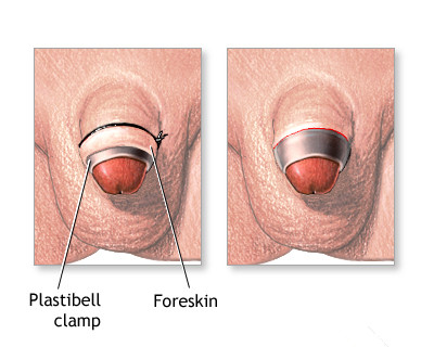 Plastibell Circumcision Healing