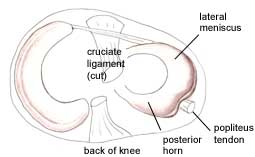 Posterior Horn of Medial Meniscus