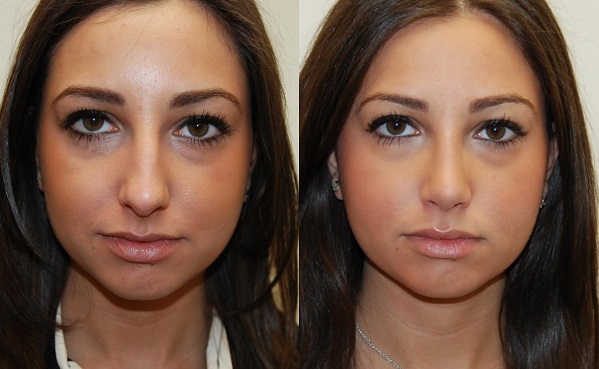 Nose Job Before and After