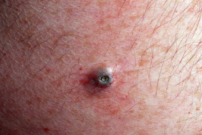 3 Steps to Deal With Dilated Pore of Winer | New Health Advisor
