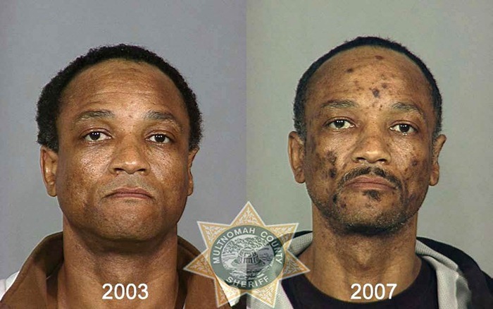 Heroin Addict: Before and After
