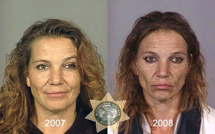 Heroin Addict: Before and After