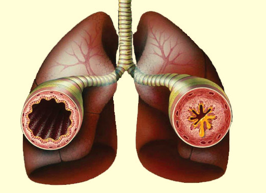 Reactive Airway Disease: Symptoms and Treatments