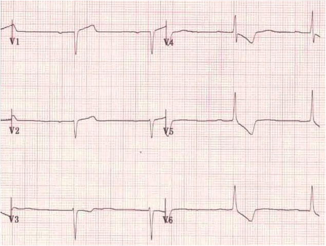 Bad R-tand progression.