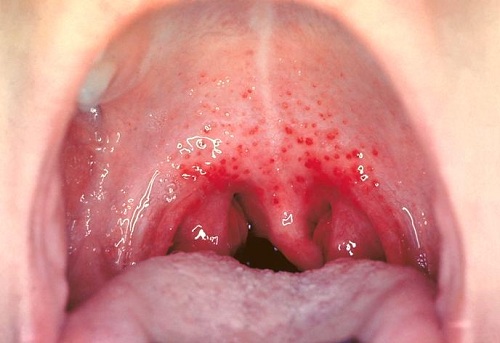 What Causes Red Spot on the Roof of Your Mouth?