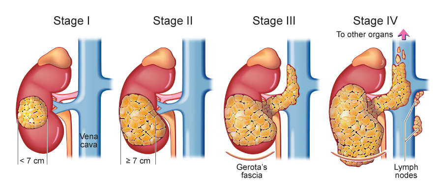 Renal Cell Carcinoma Staging