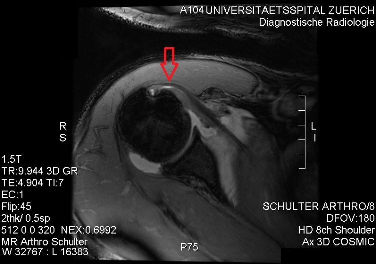Rotator Cuff Tear MRI
