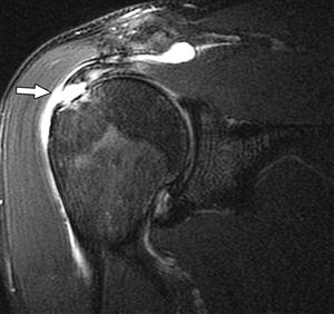 Rotator Cuff Tear MRI