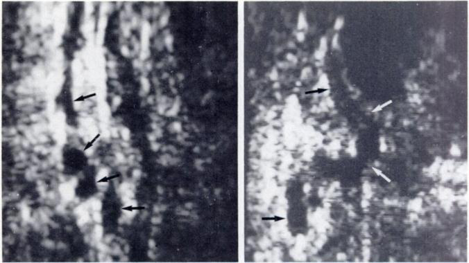 Varicocele Ultrasound
