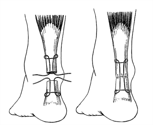 Achilles Tendon Surgery New Health Advisor