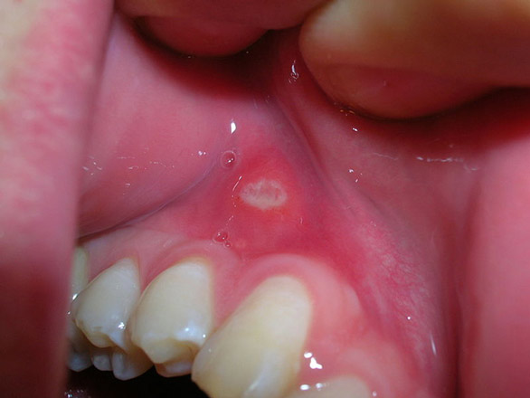White Patches in Mouth