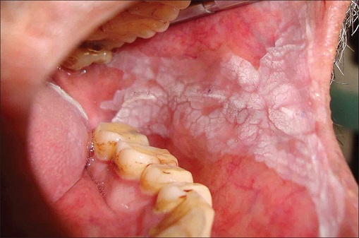 White Patches in Mouth