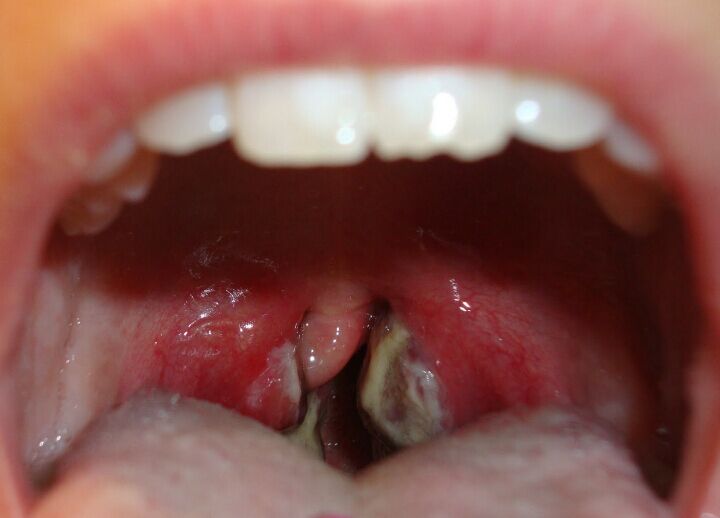 Strep white throat patches when disappear from will the White spots