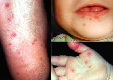 How contagious is Hand, Foot and Mouth Disease?