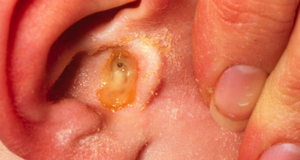 Ear Infections in Adults
