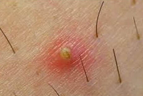Painful Lump in Armpit