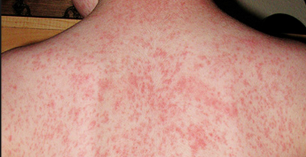 Itchy Rash All Over Body