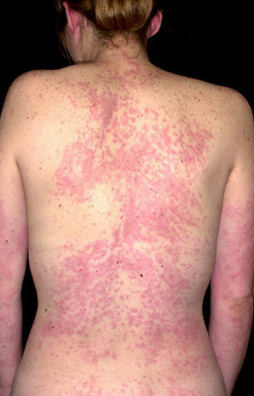 Itchy Rash All Over Body