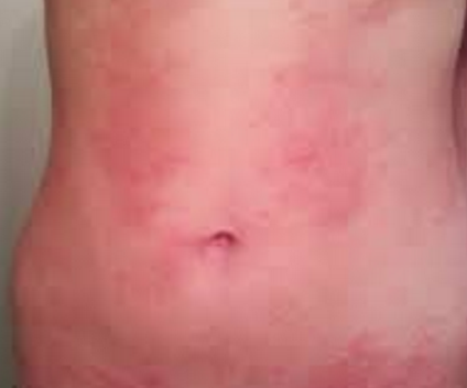 Itchy Rash All Over Body