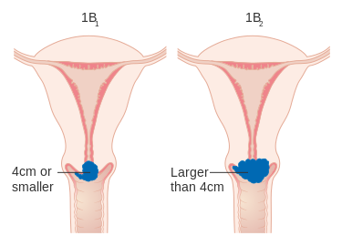 Stage 3 Cervical Cancer