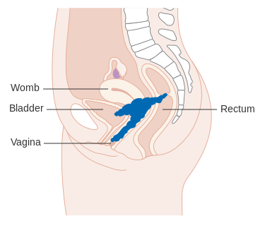 Stage 3 Cervical Cancer