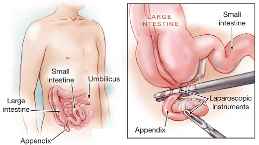 Recovery time appendix operation.