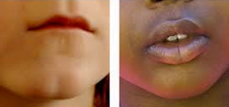Are Big Lips Dominant Or Recessive