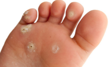 How to Deal with a Bone Spur on the Top of Your Foot