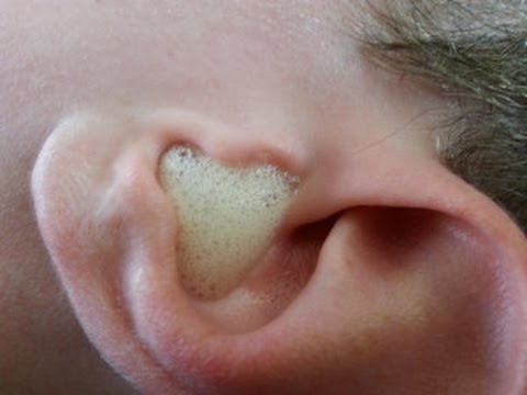 Blocked Eustachian Tube: Symptoms and Remedies